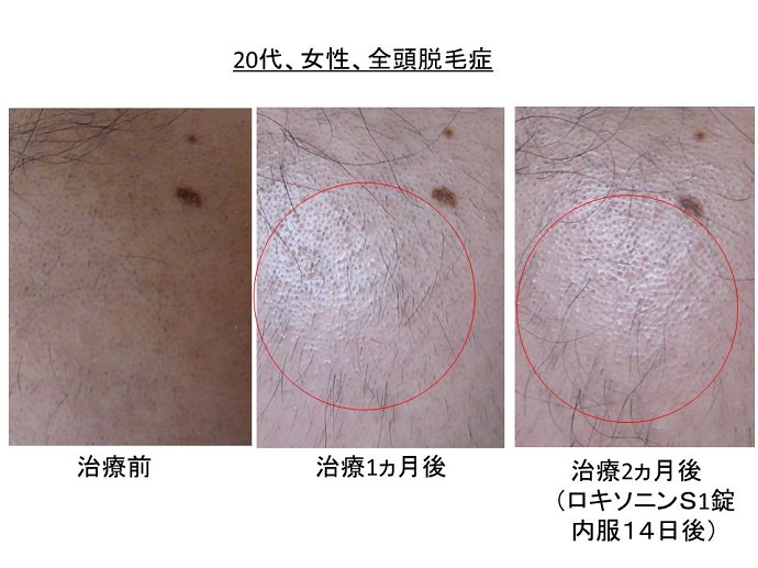 円形脱毛症　病院""